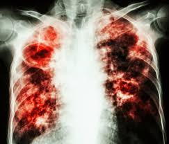 Tuberculosis: A Global Health Problem